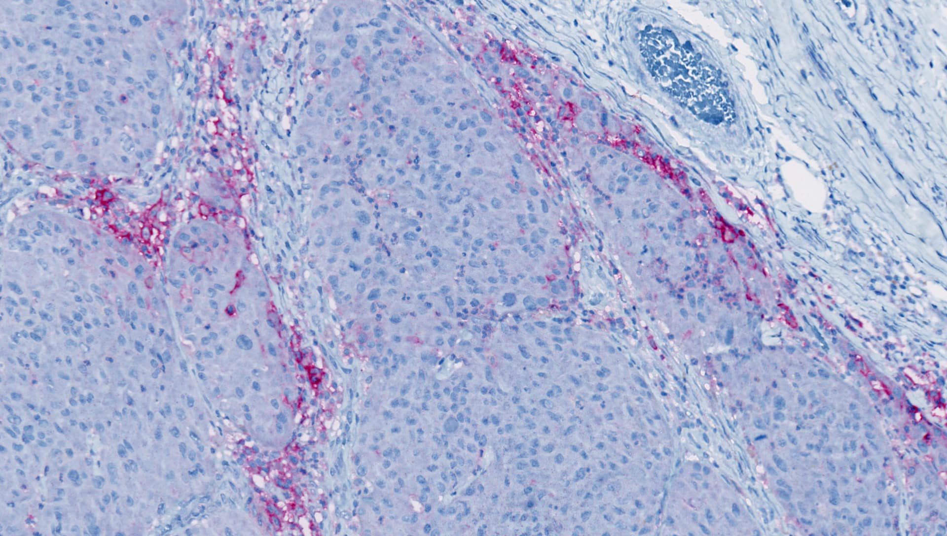 Immunohistochemical analysis of paraffin-embedded melanoma PD-L1 clone