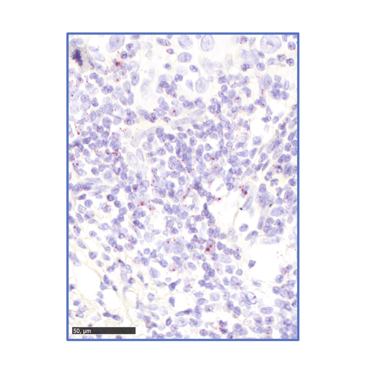 Immunohistochemical analysis of paraffin-embedded human gastric cancer tissue labeling TIA1